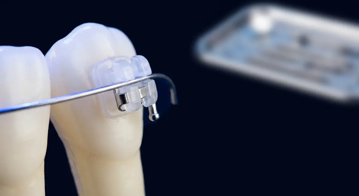 Modern self-ligating ceramic braces, orthodontic treatment at Correct Smiles Orthodontics, Gandhi Nagar Jammu